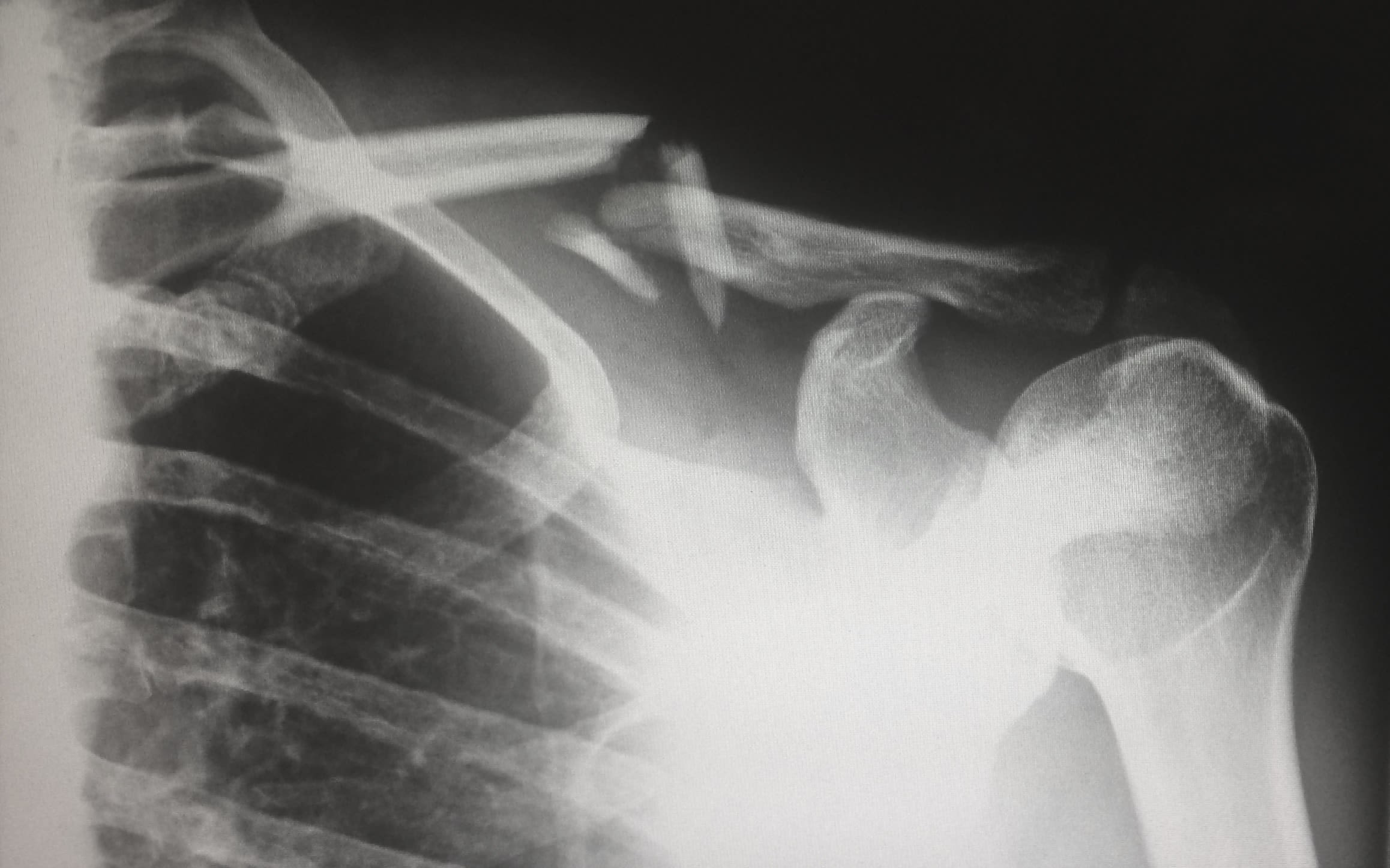 An x-ray showing a broken left shoulder